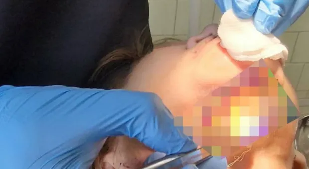 У женщины, боявшейся стоматологов, отмерла и вывалилась челюсть