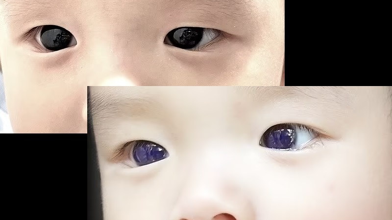 У ребёнка резко изменился цвет глаз из-за лечения от коронавируса