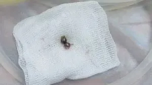 В Севастополе хирурги извлекли из ребёнка металлические шарики