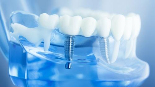 ForPost - Лечение и имплантация зубов