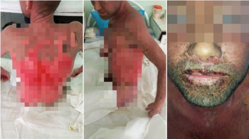 ForPost- Как кусок мяса: мужчина лишился кожи после лечения в больнице