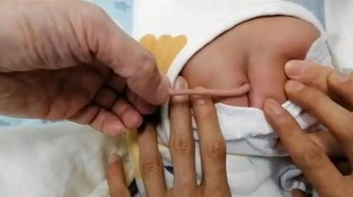 ForPost - В Китае родился младенец с хвостом