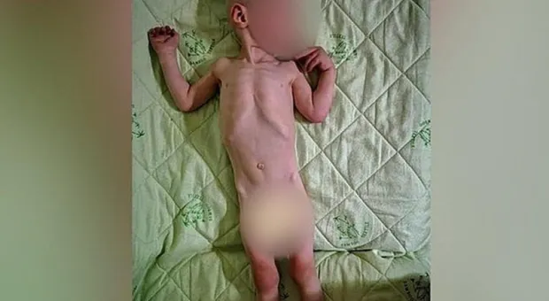 Следком не нашел уголовщины в деле истощенного ребенка из Крыма