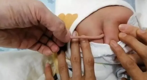 В Китае родился младенец с хвостом