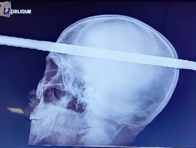ForPost - Новости : Строитель выжил после того, как металлический прут насквозь пронзил его голову