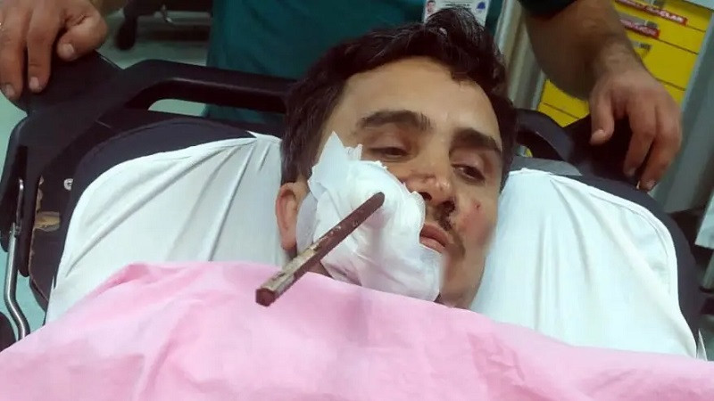 ForPost - Новости : Мужчина пробил лицо куском арматуры и чудом выжил