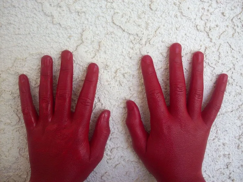 Красные руки признали симптомом неизлечимой болезни