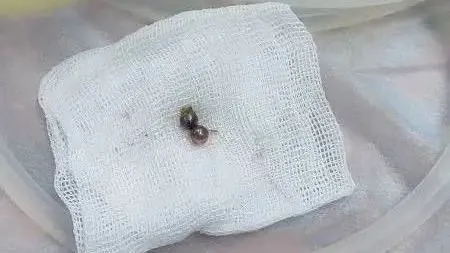 В Севастополе хирурги извлекли из ребёнка металлические шарики