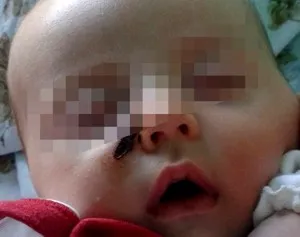 Ребенок в Севастополе получил ожог от брошенного окурка: в возбуждении уголовного дела отказано