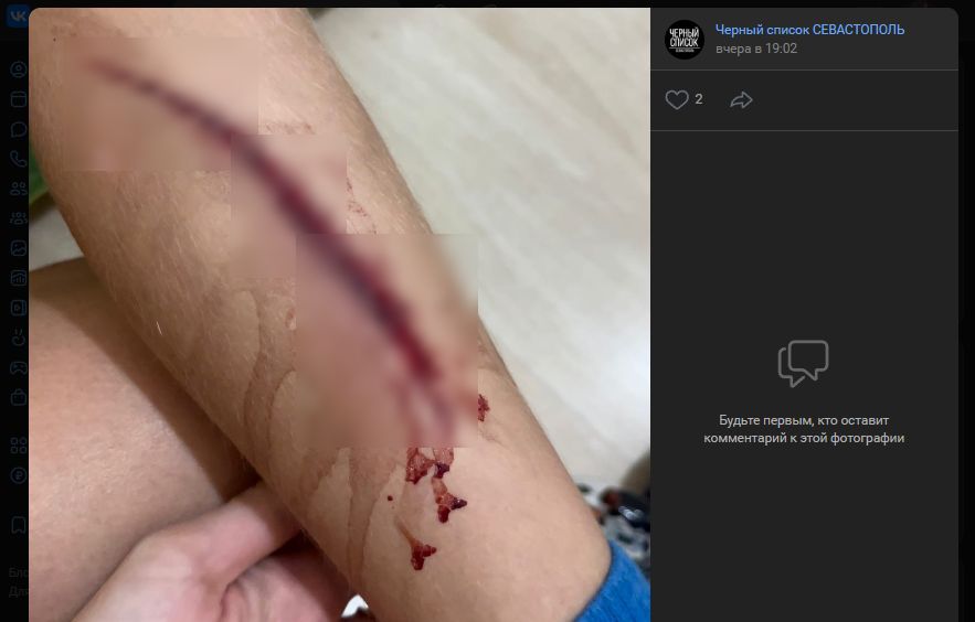 севастополь ребенок поранил ногу в Динопарке на скейте